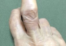 諦めていた手の痛みとフェバーデン結節がグンと改善